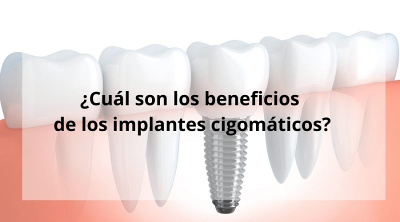 Cuál son los beneficios de los implantes cigomáticos Blog MQM