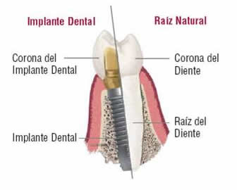 Implante vs Raíz natural