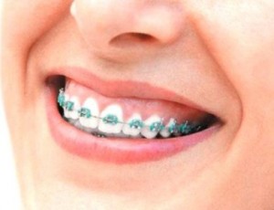 Brackets - Ortodoncia