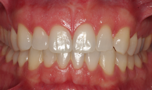 Cierre de diastema