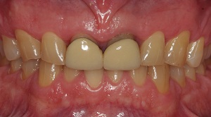 Foto 2. alargamiento quirúrgico de los dientes