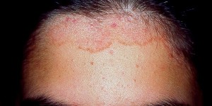 Dermatitis Seborreica