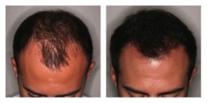 Sí es posible recuperar el pelo a los 30