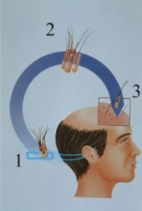 ¿Cómo se realiza un injerto capilar-Técnica FUSS o trasplante de pelo con la técnica de la tira?