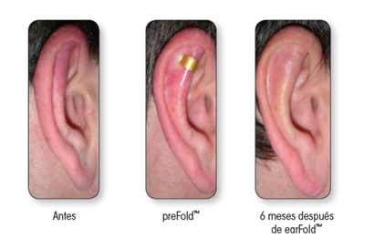 EarFold: Orejas de "soplillo" antes y después