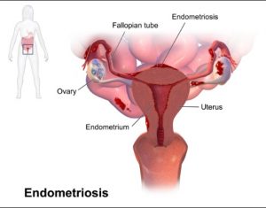 endometriosis