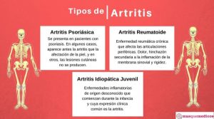 Tipos de artritis. Síntomas y diagnóstico