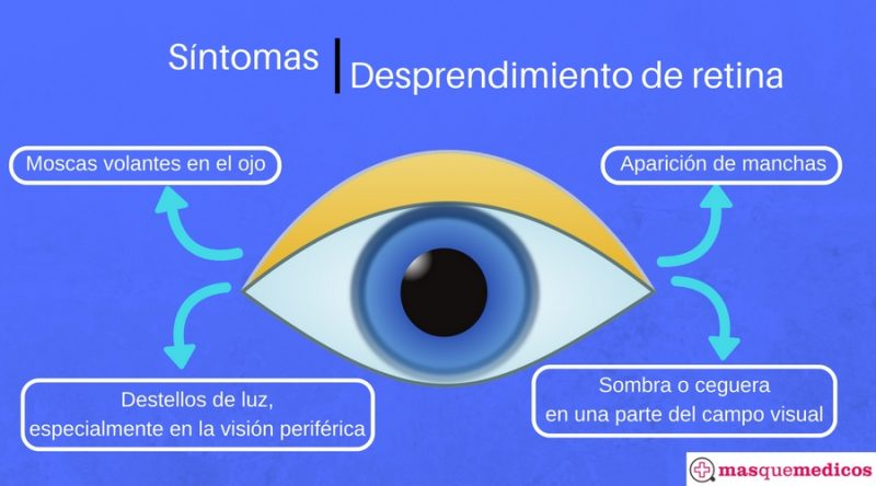 Síntomas del desprendimiento de retina