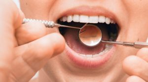 Qué es la gingivitis y cómo tratarla