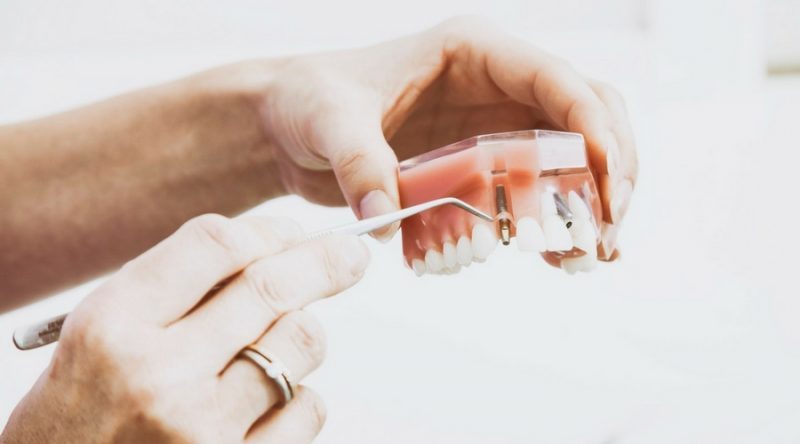 implantes dentales caredent