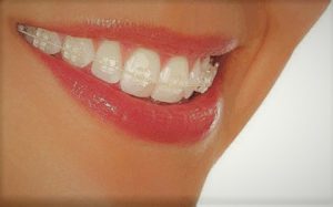 ortodoncia-transparente