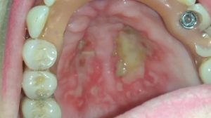¿Qué es la gingivoestomatitis herpética?