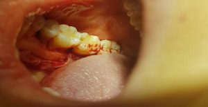 Limpiezas dentales para evitar las enfermedades periodontales