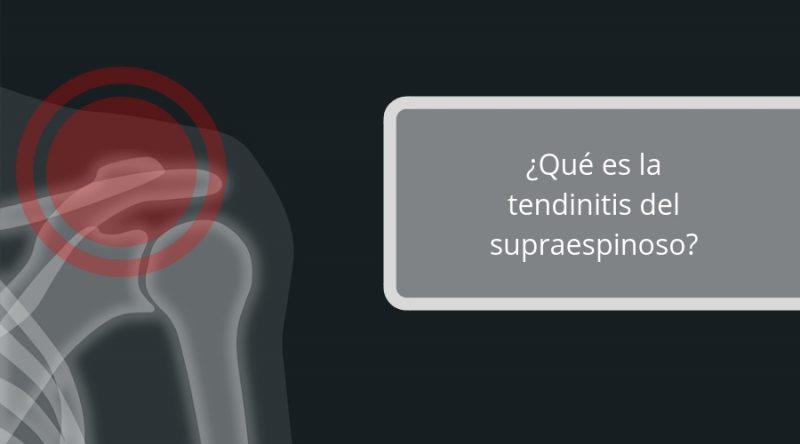¿Qué es la tendinitis del supraespinoso_