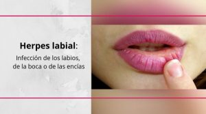 Todo lo que debes saber sobre el herpes labial