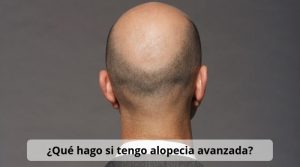 ¿Qué hago si tengo alopecia avanzada?