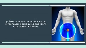 ¿Cómo es la intervención de la hiperplasia benigna de próstata con láser de tulio?
