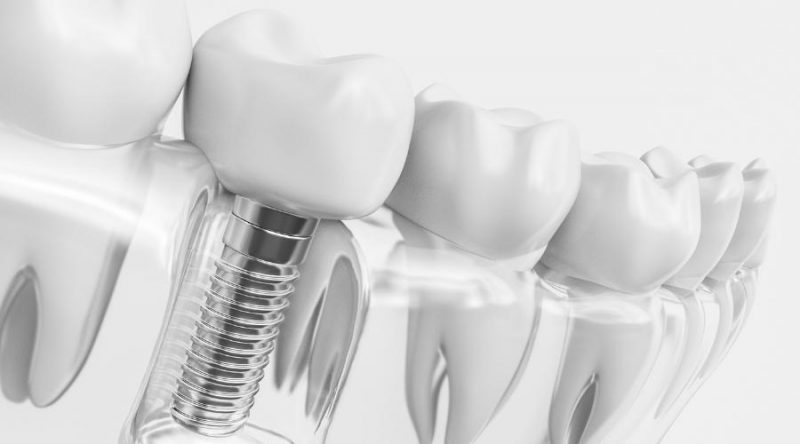 ¿Los implantes dentales pueden colocarse a cualquier edad?