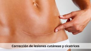 Corrección de lesiones cutáneas y cicatrices