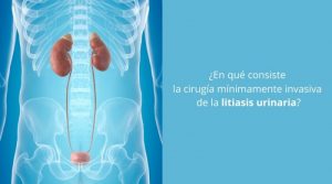 ¿En qué consiste la cirugía mínimamente invasiva de la litiasis urinaria?