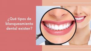¿Qué tipos de blanqueamiento dental existen?
