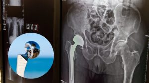 Mejoras en la cirugía de prótesis total de cadera