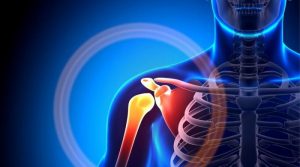3 Consejos tras una fractura de hombro
