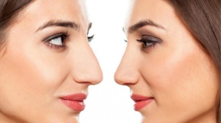 ¿Cómo corregir la nariz aguileña? - Blog de Masquemedicos