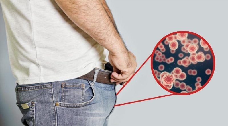 7 preguntas frecuentes sobre el virus del papiloma humano en hombres
