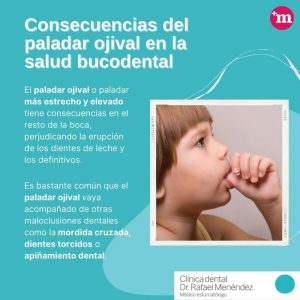 Consecuencias del paladar ojival en la salud bucodental