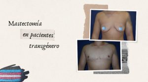 Mastectomía en pacientes transgénero