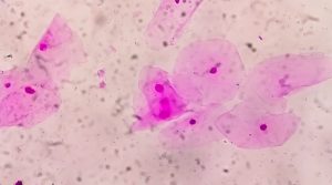 vaginosis bacteriana