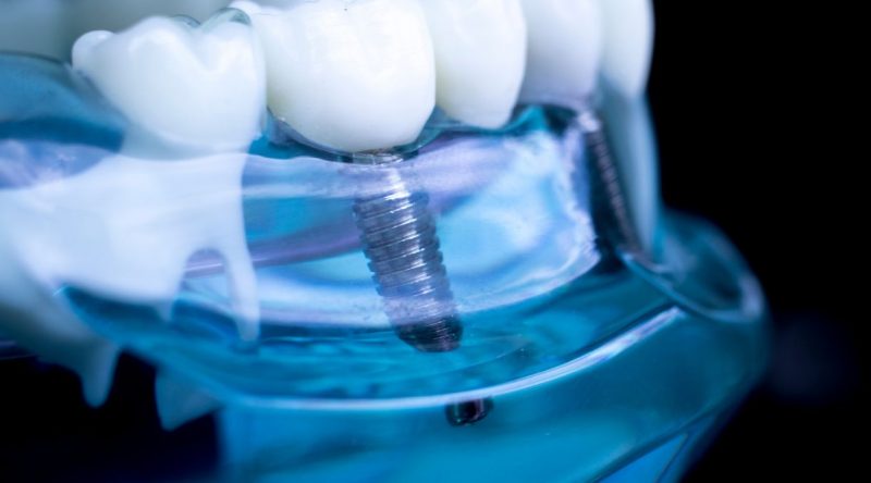 Osteointegración implantes dentales IMOI