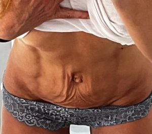 BodyTite Antes