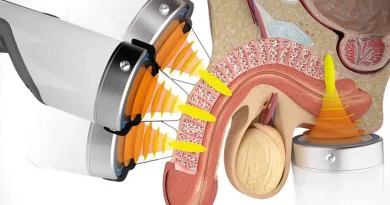 ondas de choque para la disfunción eréctil