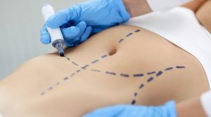 Preoperatorio cirugía plástica