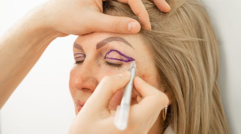blefaroplastia