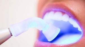 ¿Se te ha caído un empaste? Descubre por qué, cómo evitarlo y soluciones