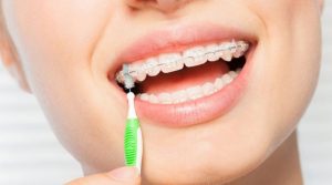 Brackets de zafiro: la ortodoncia estética que cuida tu imagen sin renunciar a la eficacia