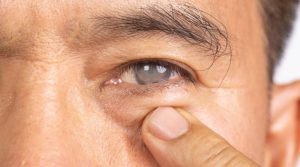 Cataratas: por qué operarse a tiempo marca la diferencia en tu visión futura