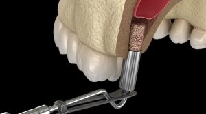 ¿Poco hueso para implantes dentales? La elevación de seno puede ser la solución que buscabas