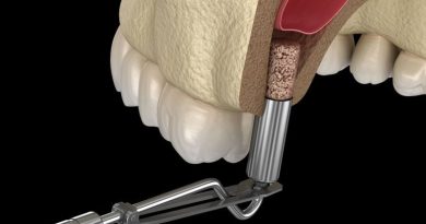 elevación de seno maxilar