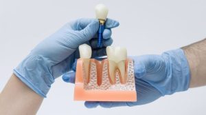 ¿Es posible poner un implante dental el mismo día que se extrae el diente?