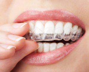 Invisalign en Valencia: lo que nadie te cuenta antes de empezar el tratamiento