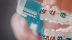 Ortodoncia y encías: cómo cuidar tu sonrisa mientras alineas tus dientes